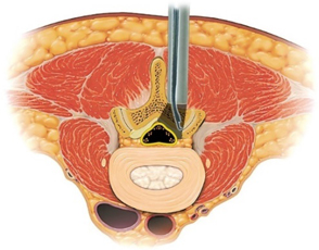 腰部脊柱管狭窄症のける除圧の様子