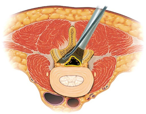 腰部脊柱管狭窄症のける除圧の様子