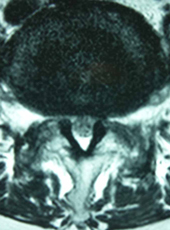 内視鏡手術で術後脊柱管を拡大した様子