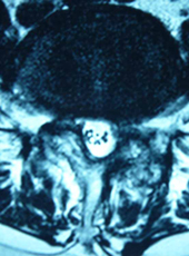 内視鏡手術で術後脊柱管を拡大した様子
