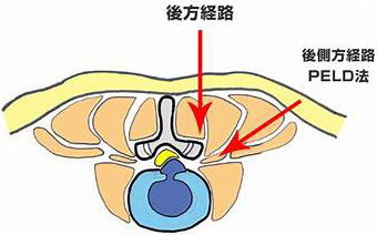 FESS法における2つの経路、後方経路・後側方経路PELD法