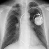 植え込み型除細動器